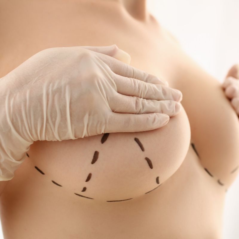 Breast Reduction