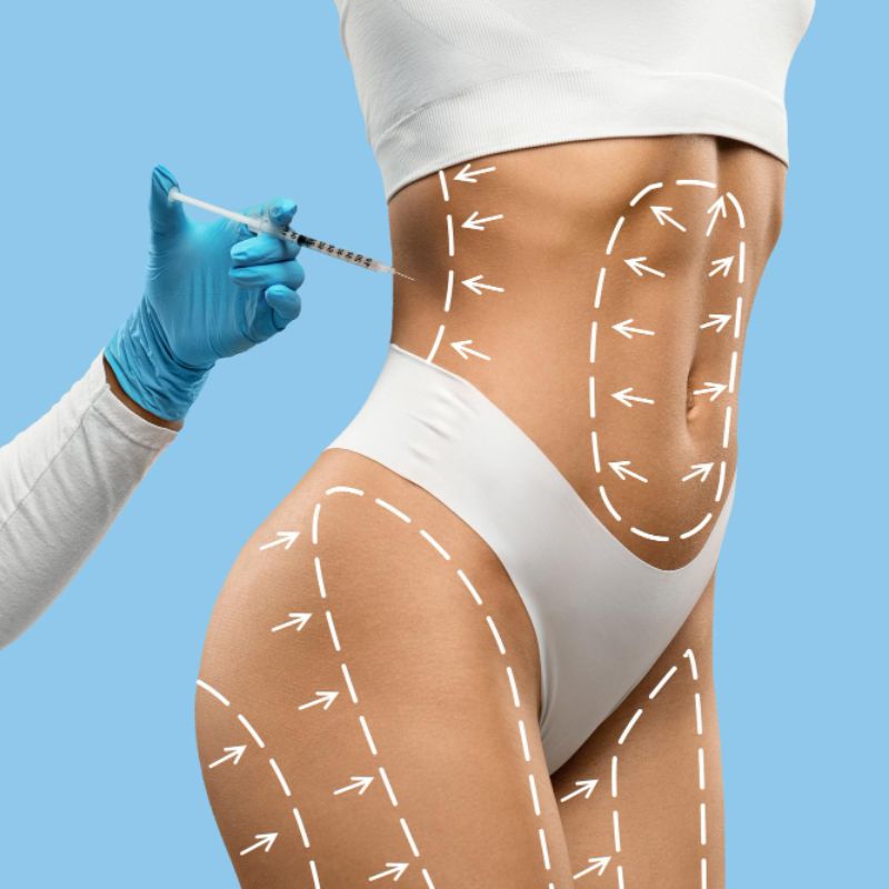 Fat Injection Augmentation