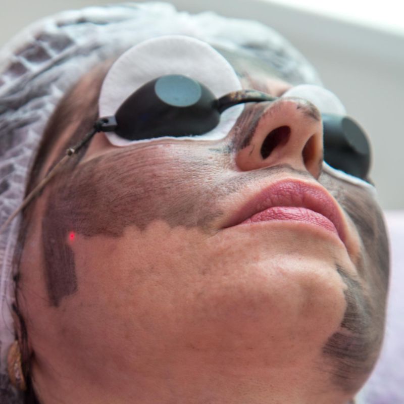 Fractional CO2 Laser