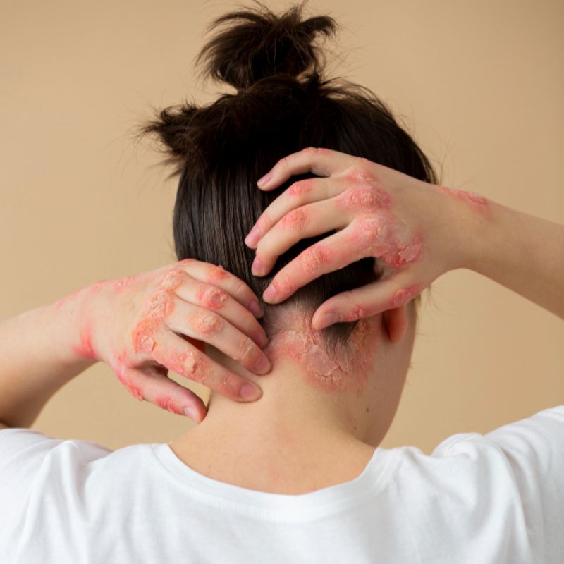 Fungal & Bacterial Skin Infections