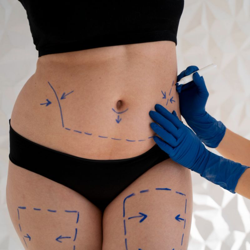 Liposuction & 3D Liposuction