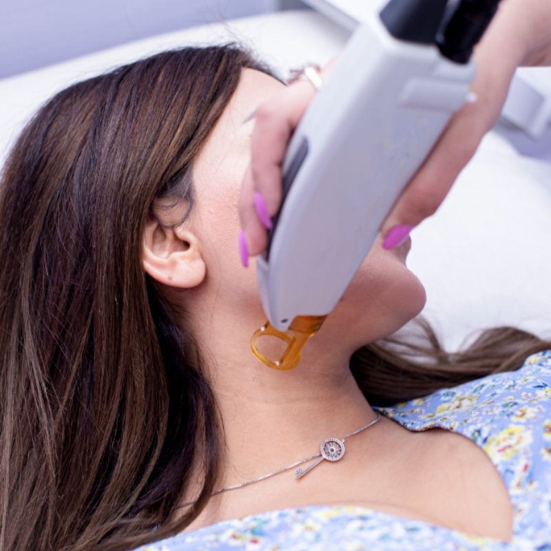 Diode Laser Hair Removal