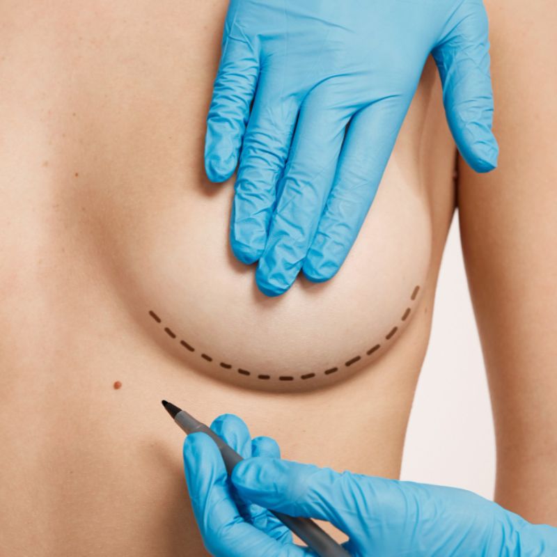 Nipple & Areola Reduction