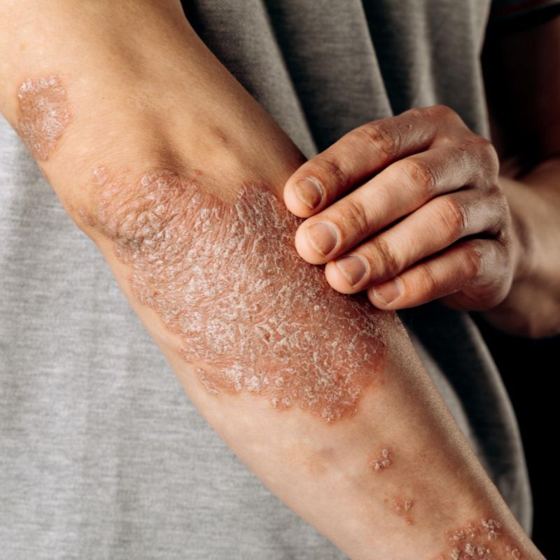 Psoriasis & Eczema
