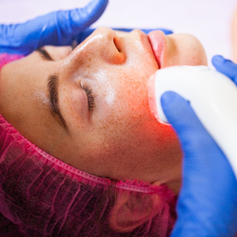 Q-Switch Laser for Pigmentation