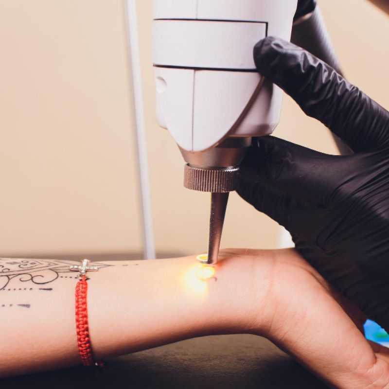 Q-Switched Laser (Tattoo & Pigmentation Removal)