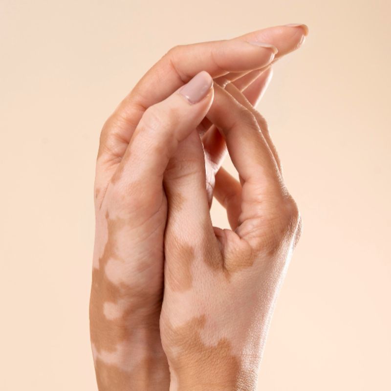 Vitiligo Treatment