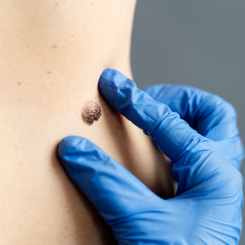 Skin Tags/Moles/Warts Removal