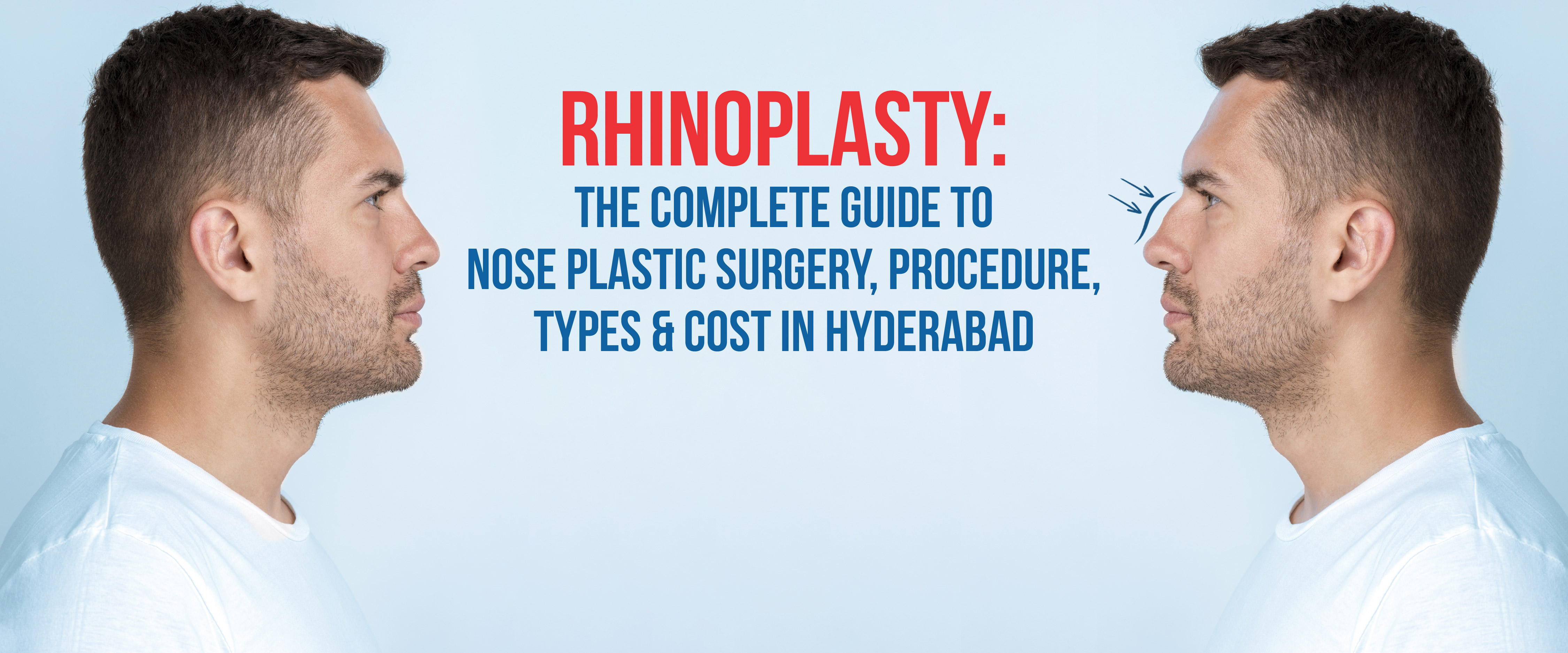 Rhinoplasty in Hyderabad